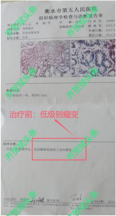 同一家医院，同一个门诊医生，先后两份报告，胃内低级别瘤变逆转，现在变为轻度肠上皮