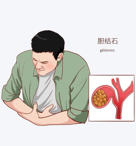 右上腹不适，可能是胆结石在“报警”，这6个部位异常要留心，警惕胆道问题！