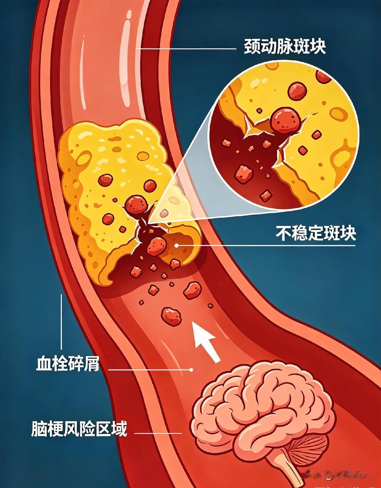 血管长了斑块，脱落风险大不大？弄懂这点，远离脑梗很多中老年人体检都会查出颈