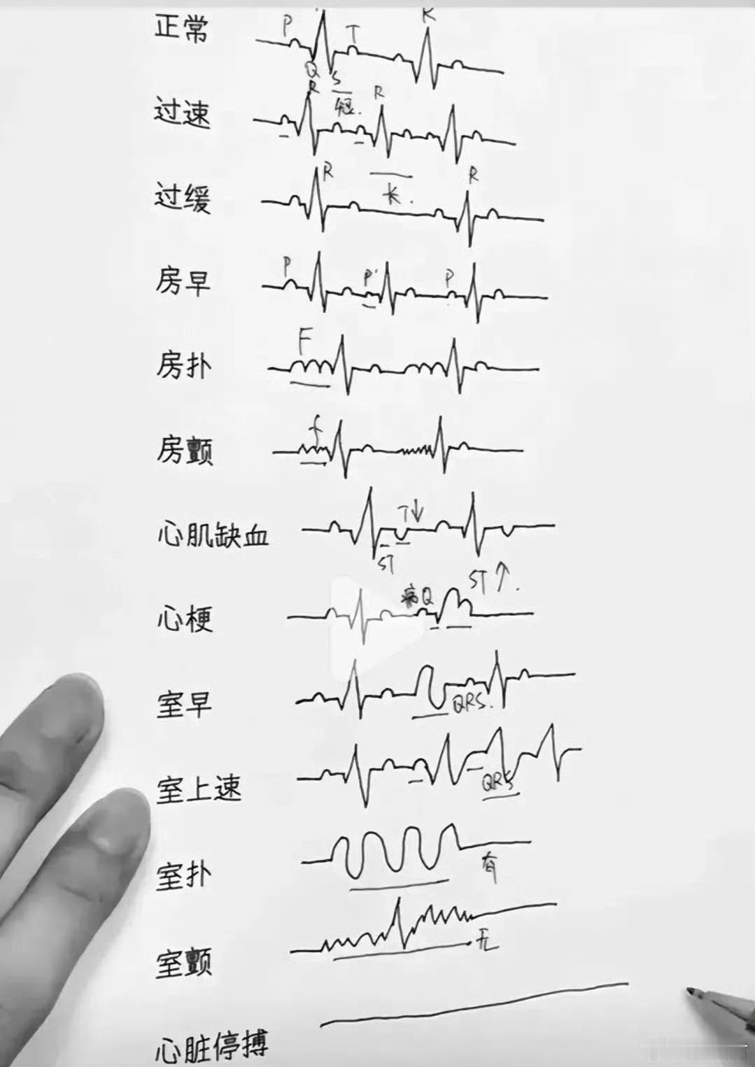 一分钟简单学会看心电图报告！​​​​