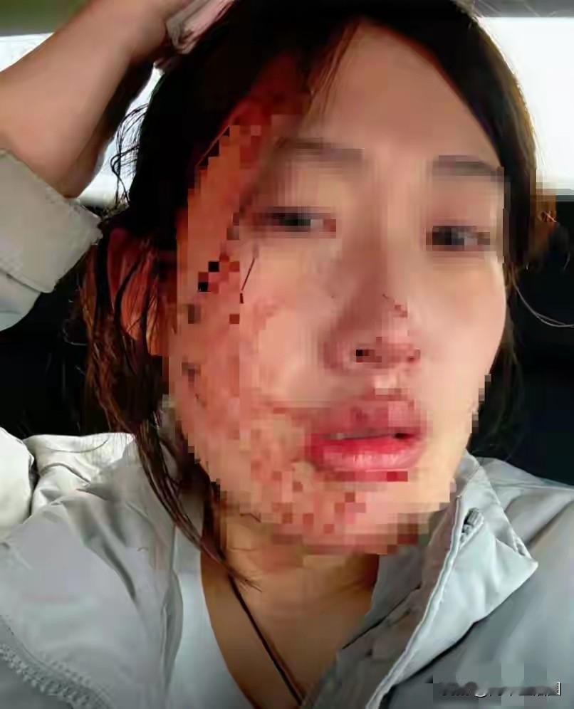 女护士因为给6岁女孩扎针被女孩父亲打出脑震荡，这事发生在河北秦皇岛。这个23