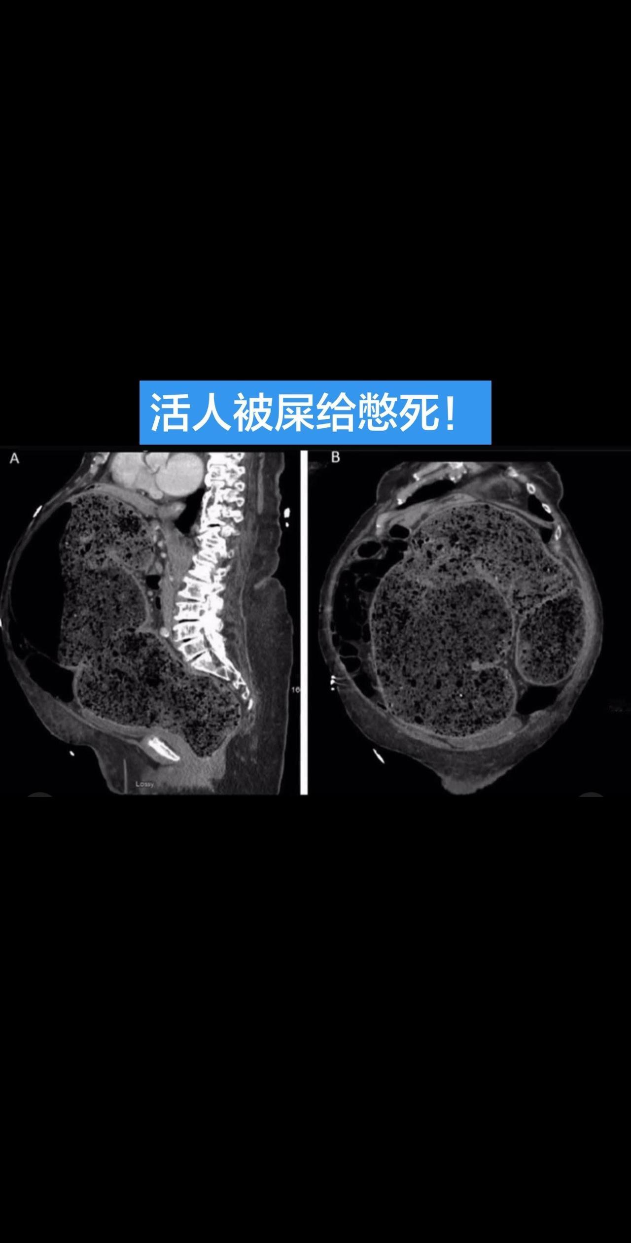 一名89岁女性，有慢性便秘病史，因腹痛、腹胀10天入院，近3天症状显著加重。10