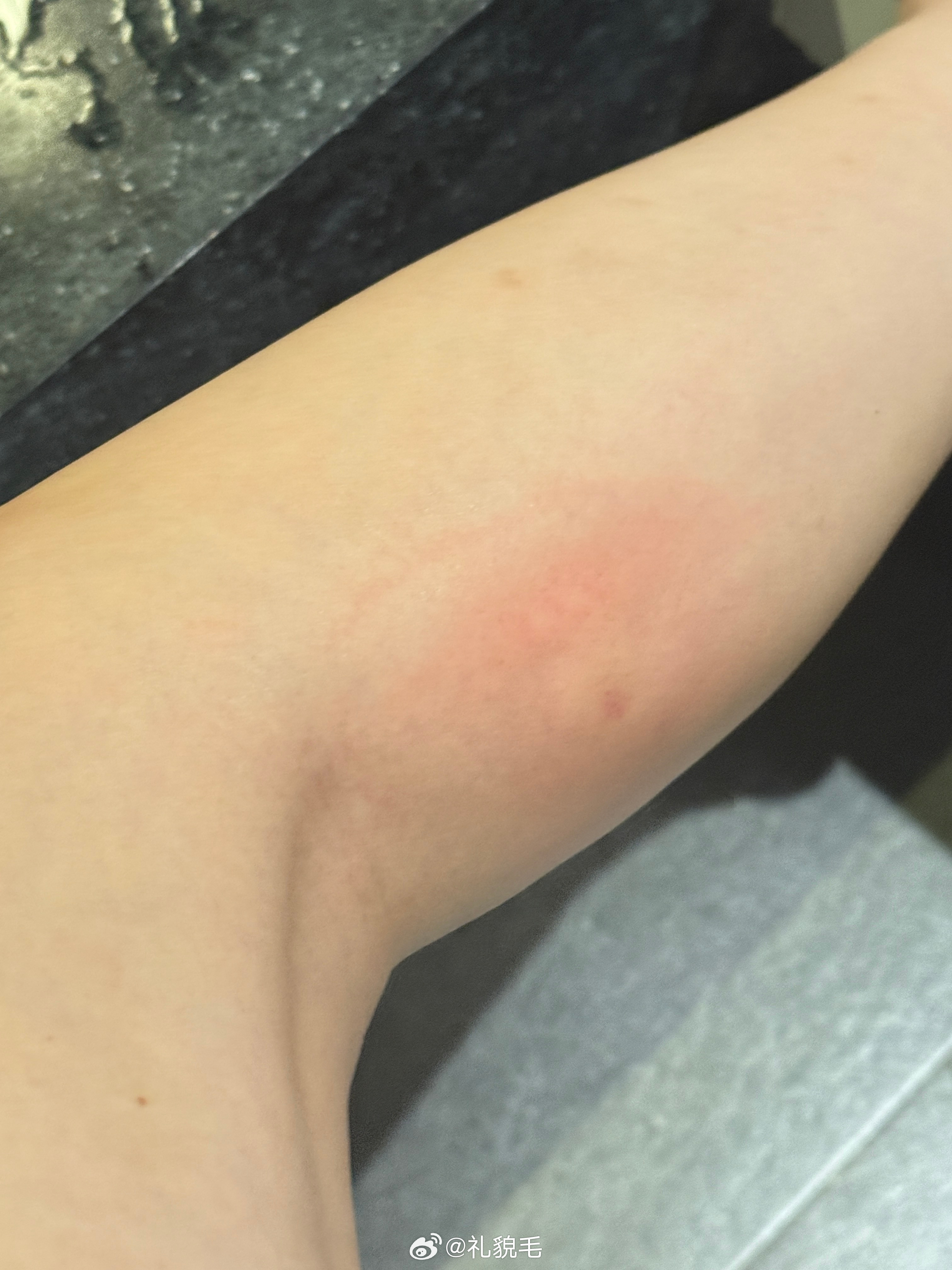 肿起巨大一个包，又痒又痛又胀李姐血泪教训分享给家人们：没事不要被蜜蜂蛰旅毛球清迈