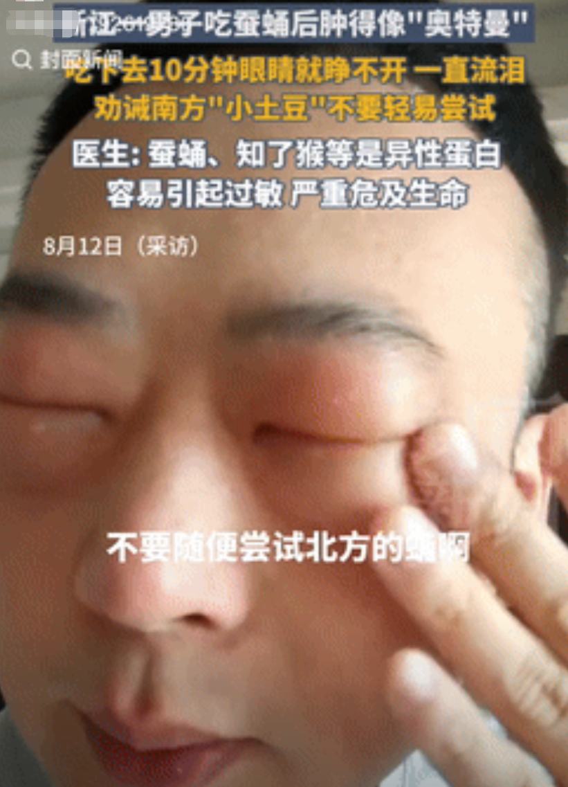 笑发财了！浙江一男子因嘴馋，买了些蚕蛹回家吃，不料吃下去仅10分钟，眼睛就肿的像