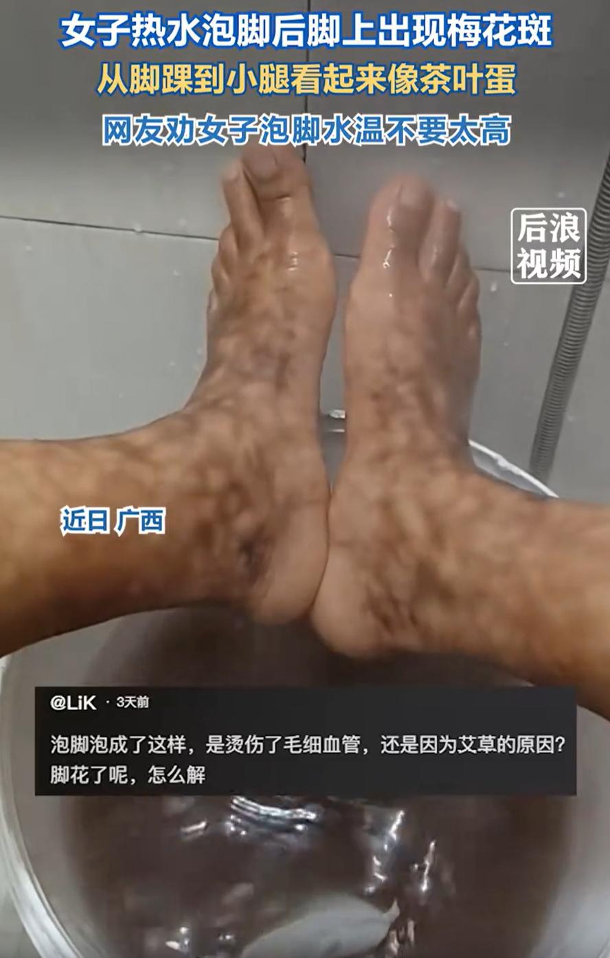 这是什么情况？广西，一女子心血来潮，想要用艾草泡脚，结果泡完后，从脚踝到小腿的位