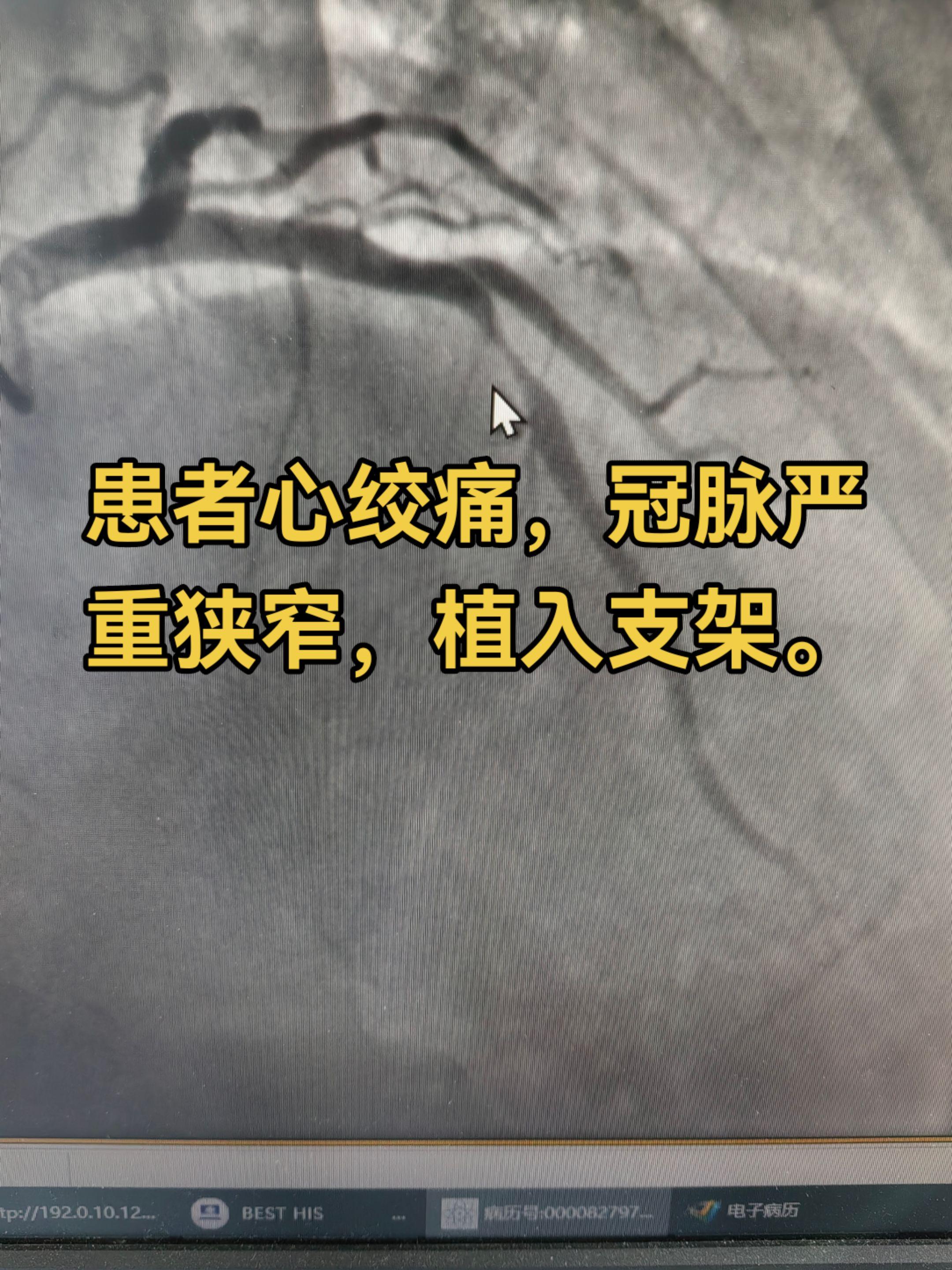 患者反复出现心绞痛，活动后明显，行冠脉造影检查提示前降支重度狭窄，最重...