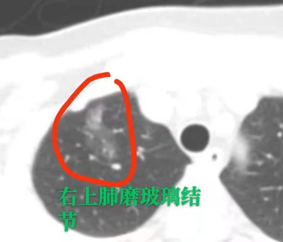 肺结节手术，能保的肺组织，绝不多切！行医这么多年，我一直认准一个原则：医生做手术