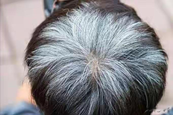 身体这处毛发变白，暗示活得不长？医生急劝：这3种情况必须检查刷到过“某处毛发变