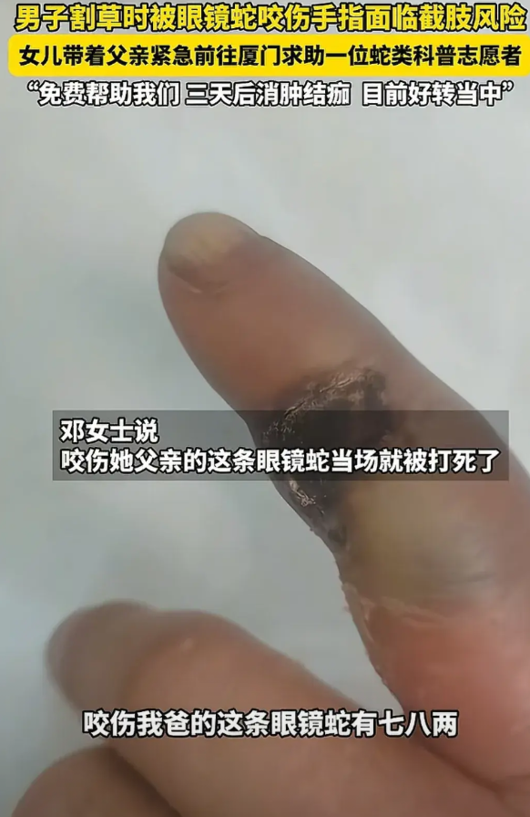 被带“火”的啊宝哥真的配享太庙！湖南一男子割草时被一条眼镜蛇咬伤手指，去医院