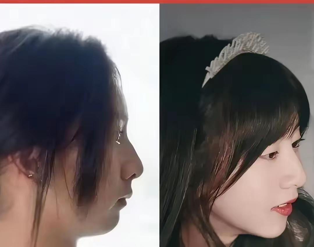 别再说14岁矫正下巴后缩晚了！森碟的矫正案例刚爆热搜，2亿网友盯着的不只是明星