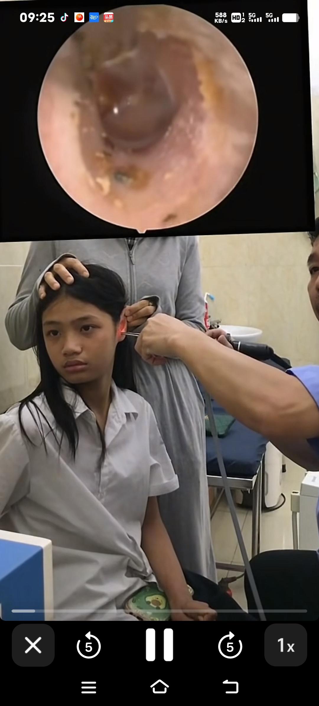 吓人！女子耳内钻心疼，医生竟取出完整虫子，背后原因令人震惊贵州毕节的翟女士因为