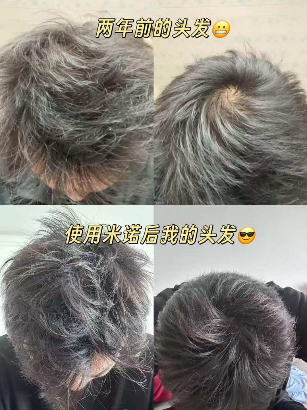 秃顶雄脱真人2年半实测📈蔓迪米诺地尔泡沫