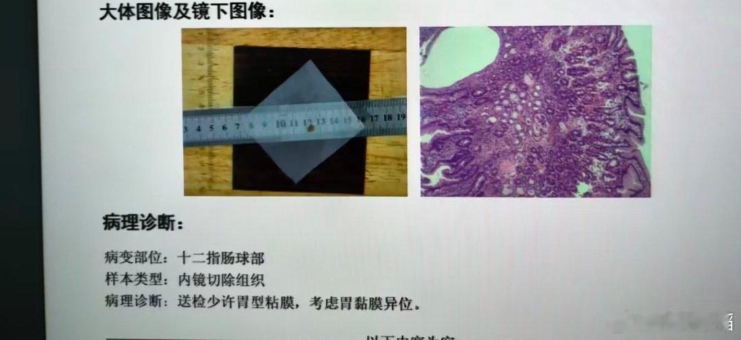 十二指肠球部胃黏膜异位一、这个病是什么？简单来说，就是本该长在胃里的黏膜组织，“