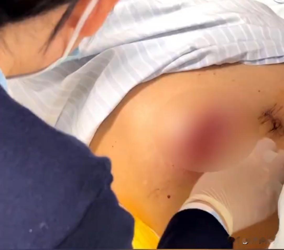 深圳，70岁老人便秘10多天，肚子胀得圆滚滚。家属急送医手术，麻醉插管时，“噗”