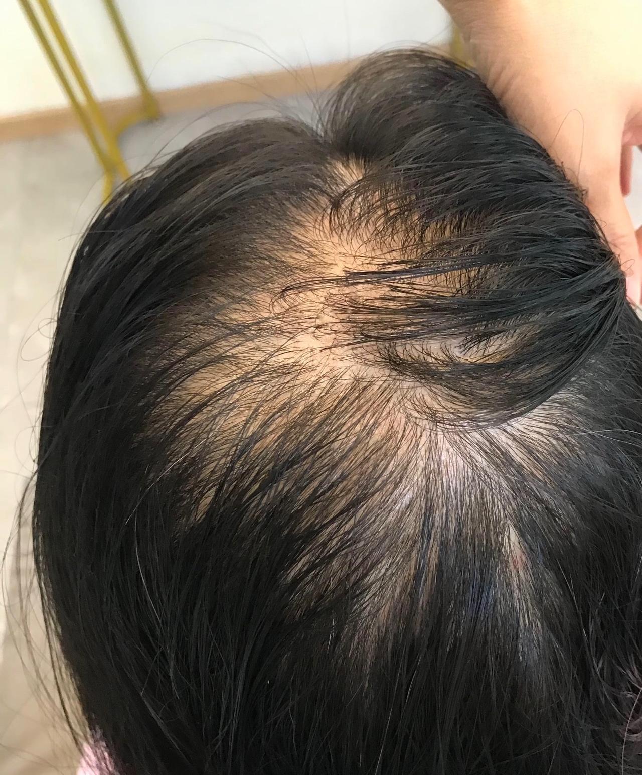 最近很流行剃光头养头发啊！有没有亲测有效的？年纪轻轻头顶秃一片不敢去理发店