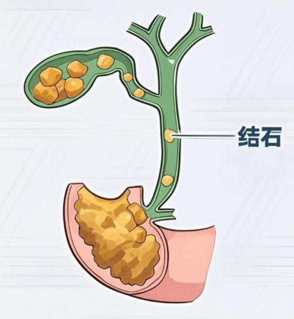 体检发现胆囊结石，送您3个“利胆小卫士”体检时若发现胆囊结石，不必过度惊慌，