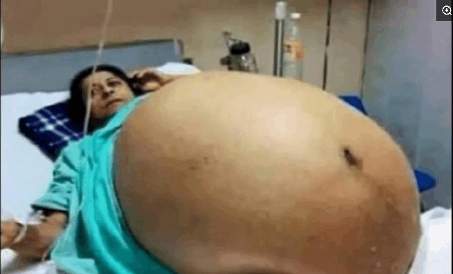 肚子都要撑破了! 一胎11个孩子10多个医生接生