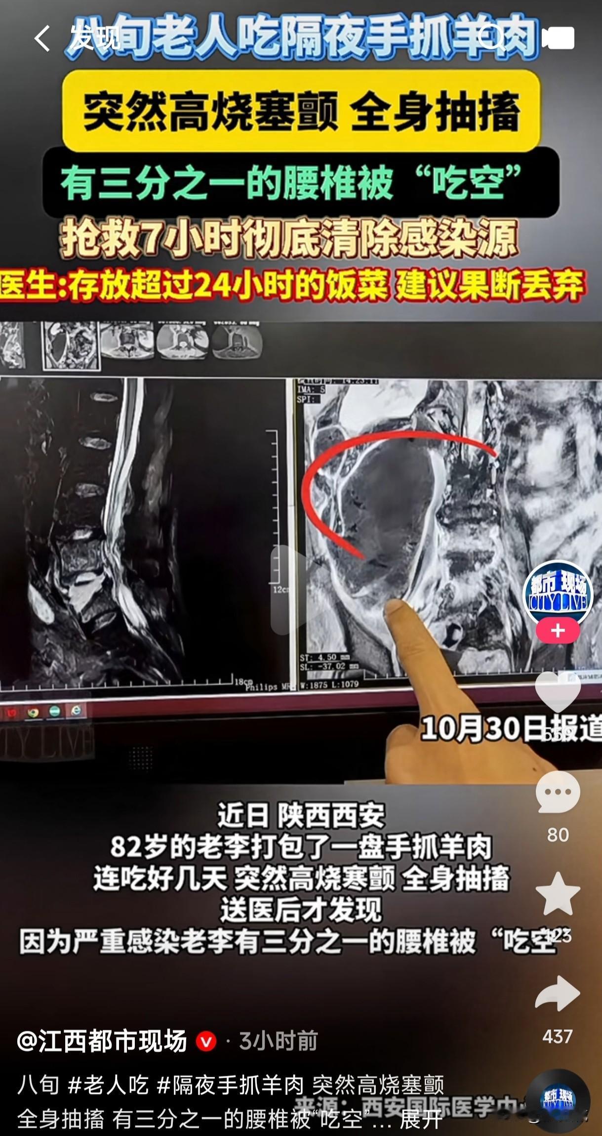 存放超过24小时的饭菜不能吃吗?82岁老人打包一盘手抓羊肉,连吃好几天突然高烧