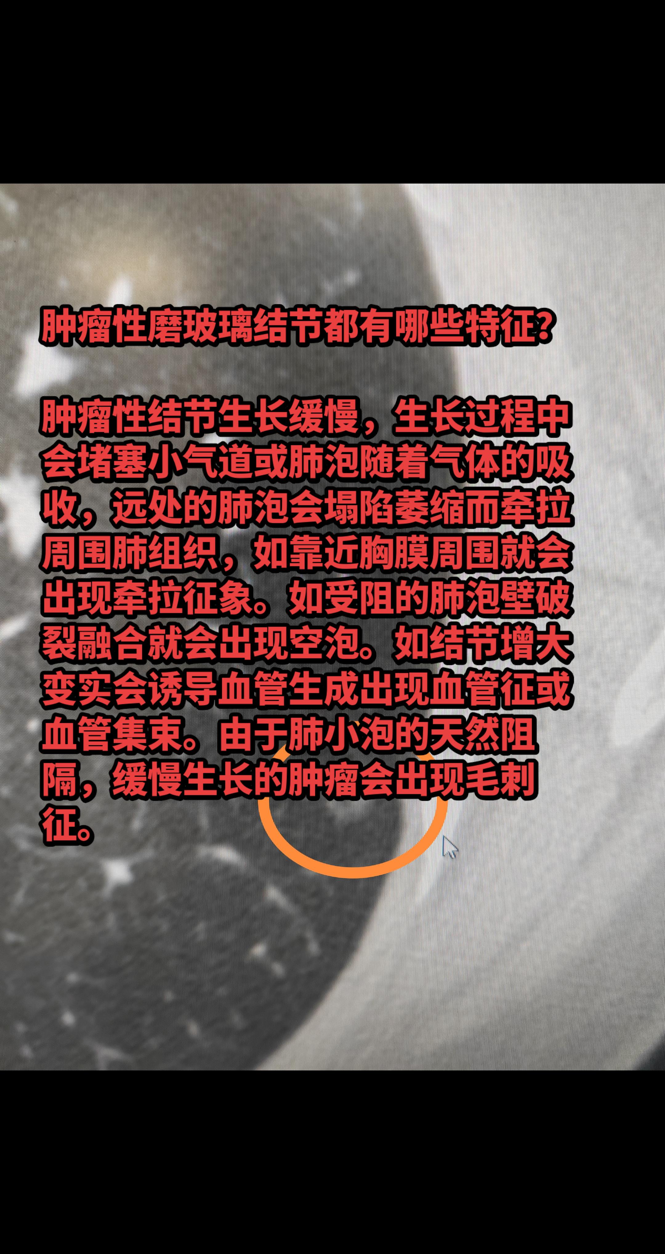 肿瘤性磨玻璃结节都有哪些特征？肿瘤性结节生长缓慢，生长过程中会堵塞小气...
