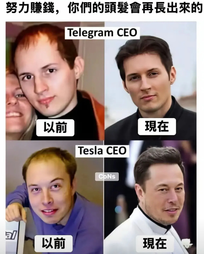 马斯克的头发到底是怎么长出来的?秃头不是基因问题吗？也只有一种可能了，就是植发，
