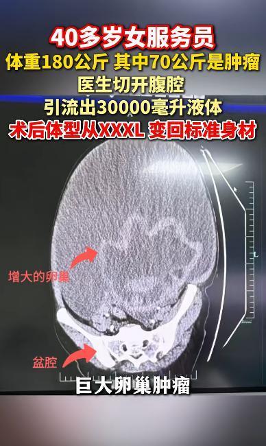 “离大谱！”5月12日报道，浙江女子减肥多年，180斤体重纹丝不动，没想到摔了一