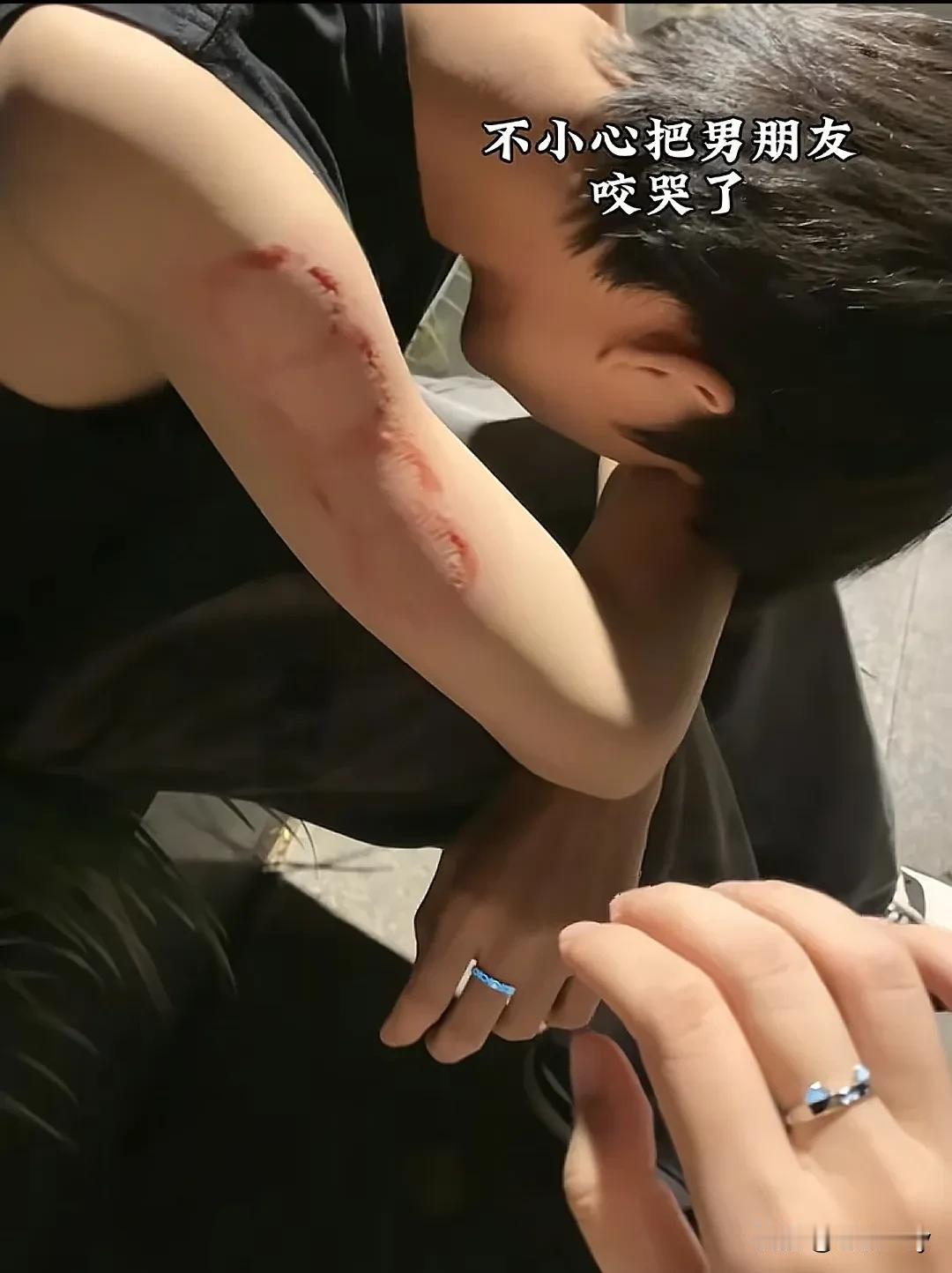 这咬合力堪比鬣狗啊！菇凉表达爱意的方式还挺硬核的，直接在男友手臂咬出了个“奥迪