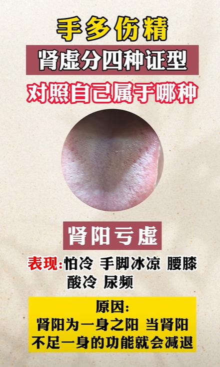 肾虚分4种证型，对照症状，看看你是哪一种？