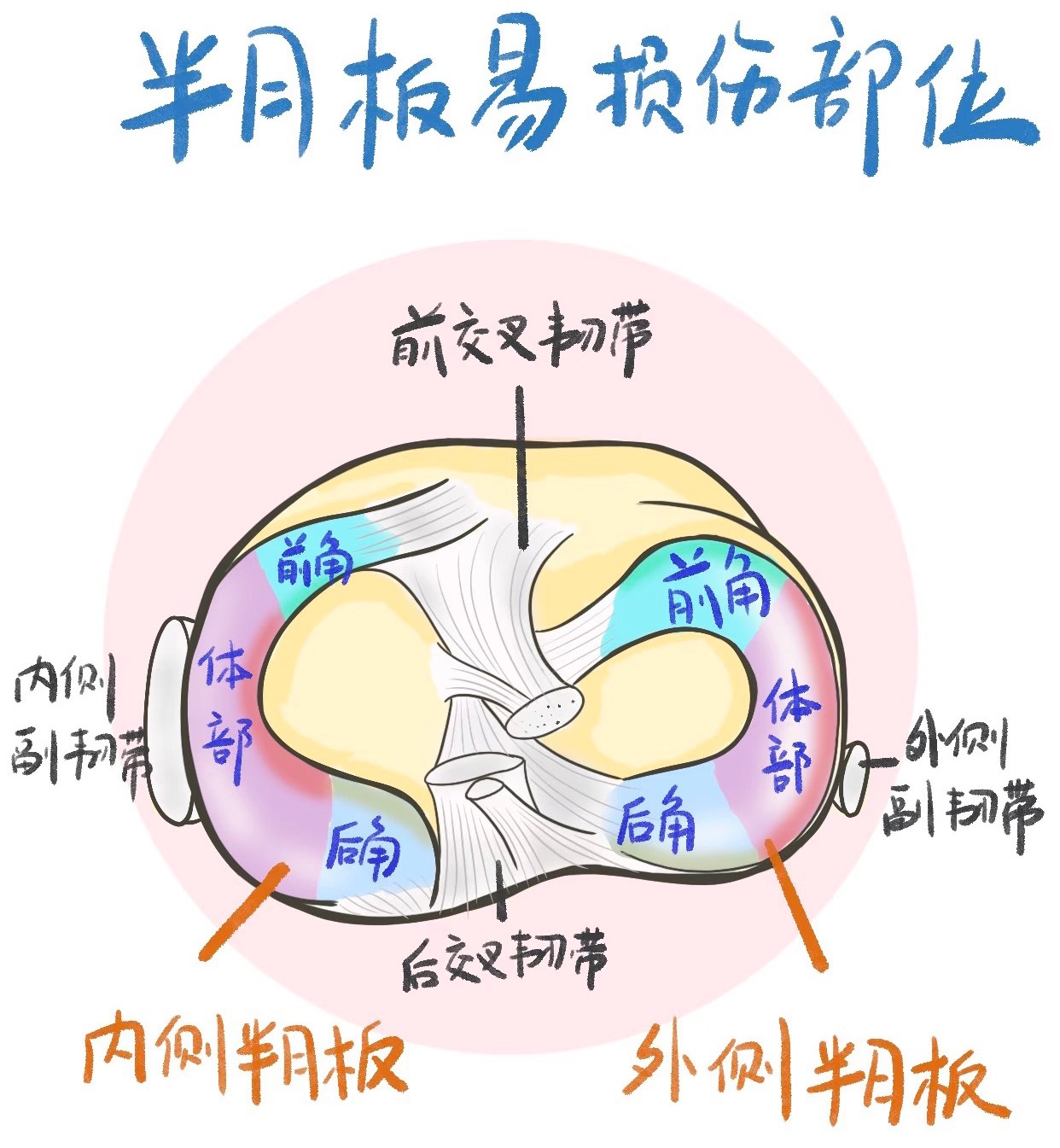 膝关节损伤今天继续来讲讲咱们的半月板——半月板损伤最常见于内侧半月板，其次为外