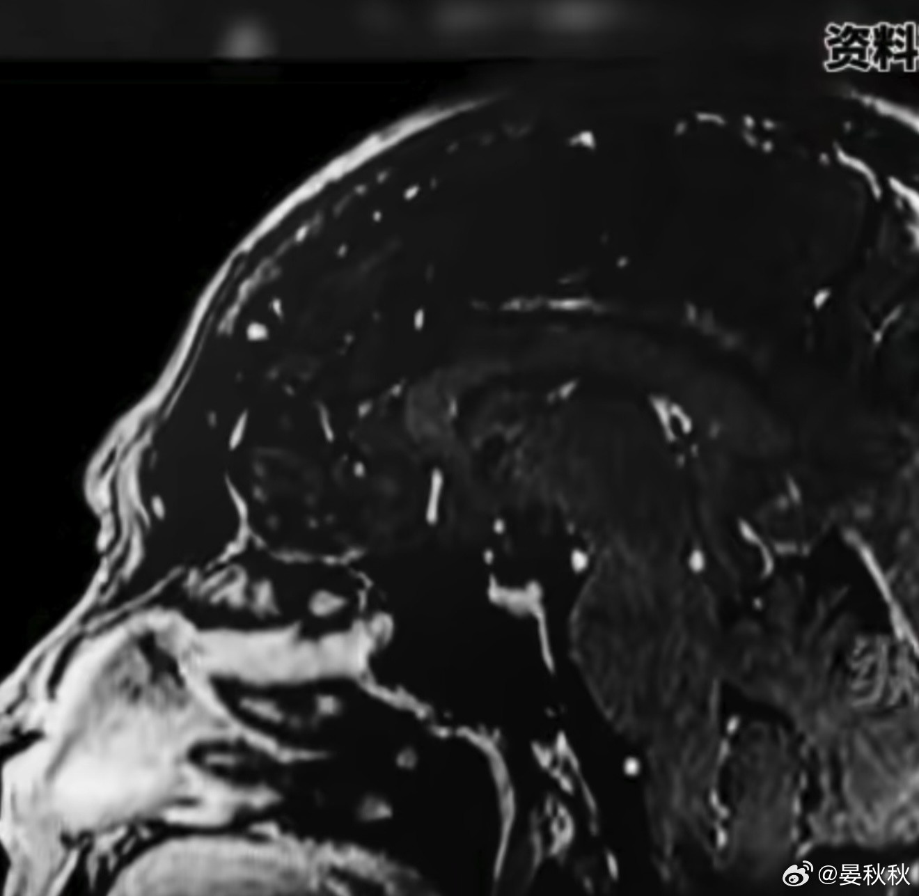 21岁脑梗浙江一位21岁的女大学生，早上醒来觉得头特别晕，照镜子一看，嘴巴好像也