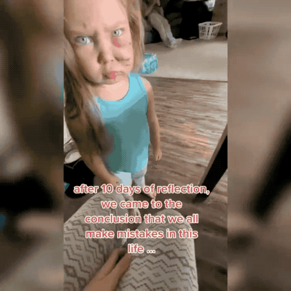 在当狗奴上美国白人还是领先：宠物狗咬伤女儿脸留下伤疤，还要留下原谅它！美国一只家