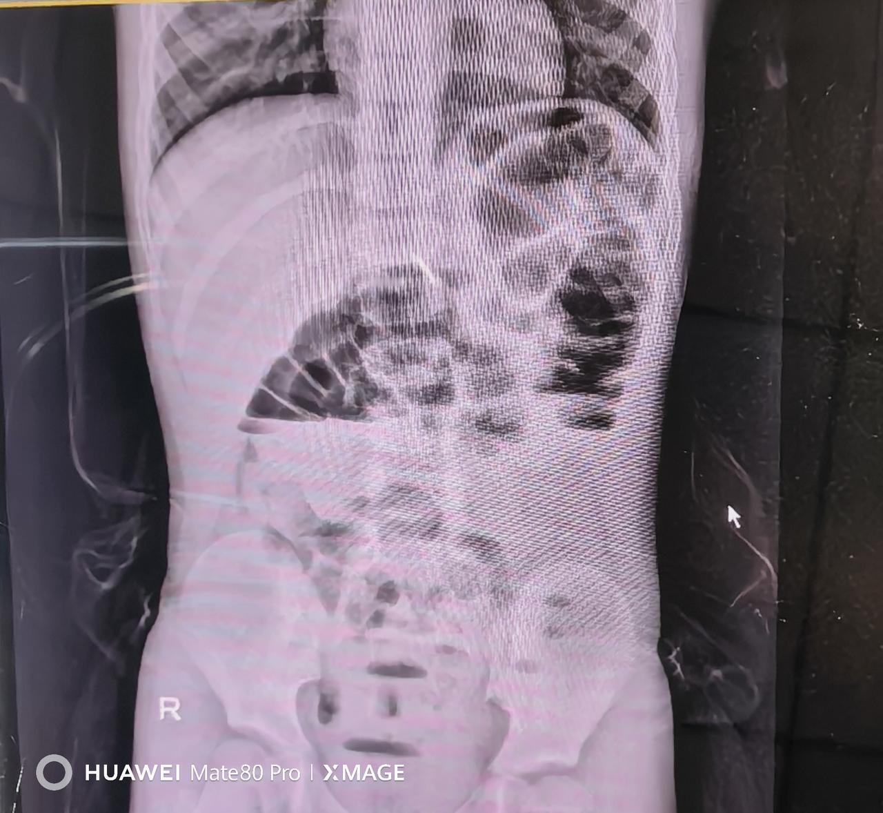 最近接诊了一个6岁小男孩，腹痛2天，还上吐下泻，当地医院拍了腹部立位片，看到明显