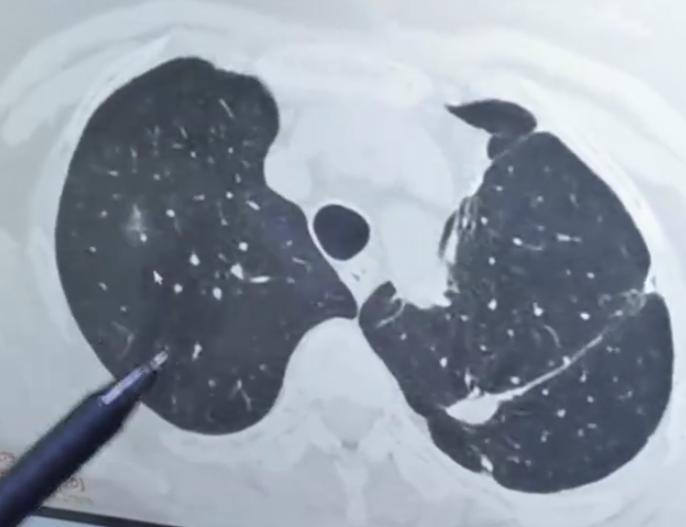 “主任，我手术前明明一点症状都没有，怎么切完肺结节之后，反而咳个不停？是不是手术
