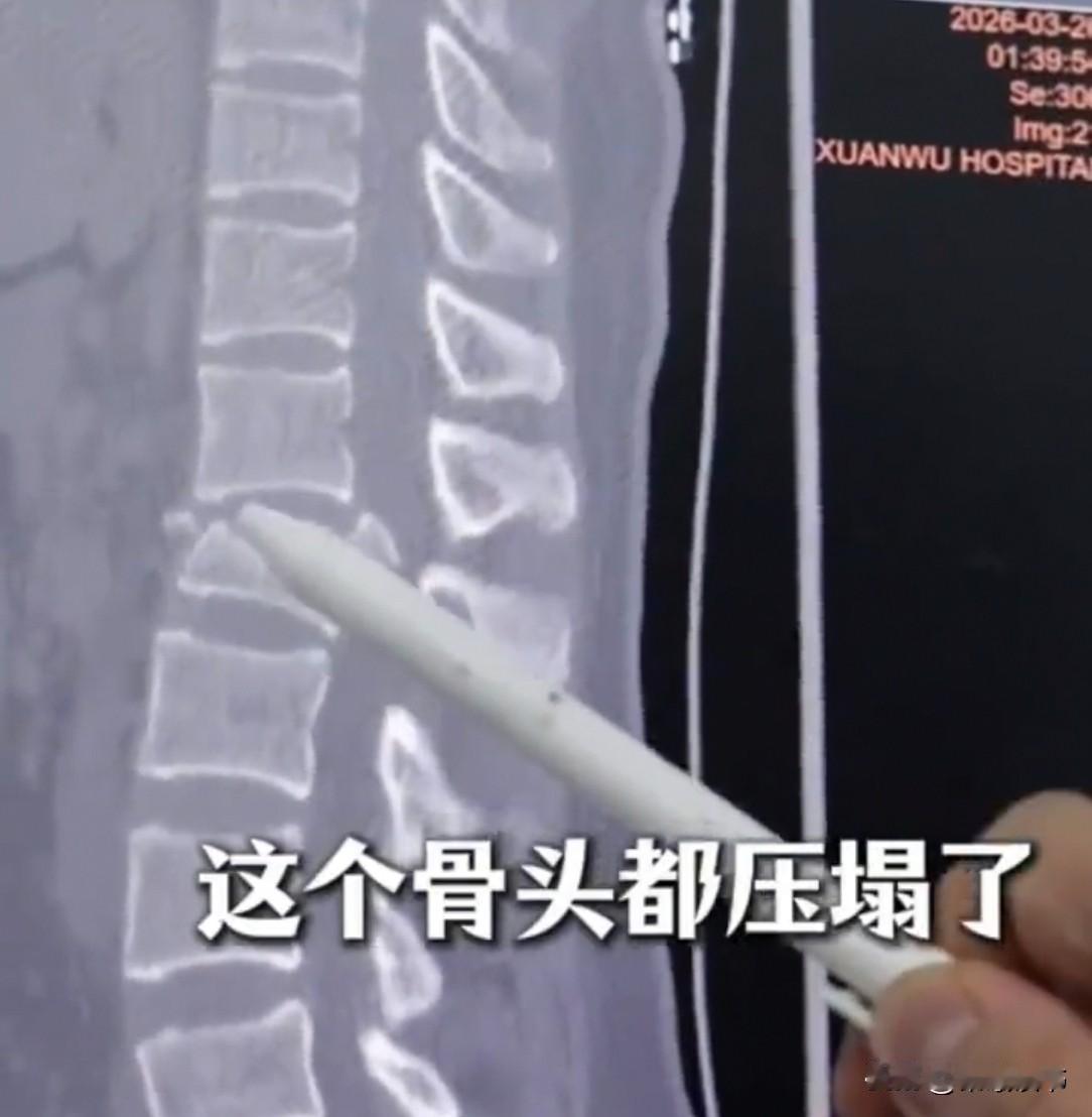 北京25岁女子在医院醒来，双腿没知觉，大小便也控制不住。医生无奈告诉她，腰椎摔爆