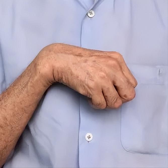 偏瘫手指蜷缩伸不开？两步帮你慢慢打开！方法一：辅助伸展训练这个方法需要家人