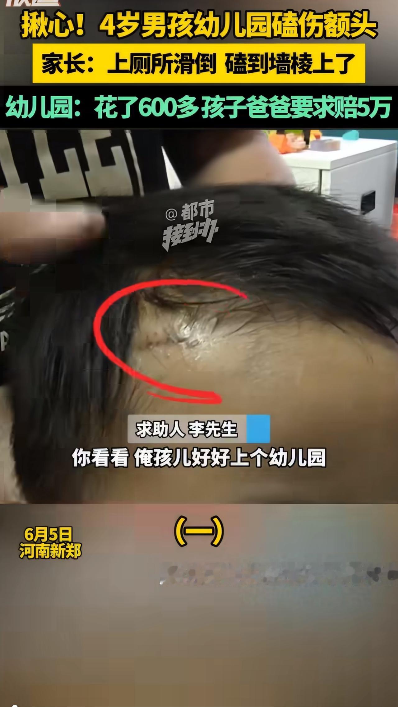 河南一4岁的小男孩在幼儿园里不小心磕伤了，结果家长转头就找园方索赔5万8，这事儿