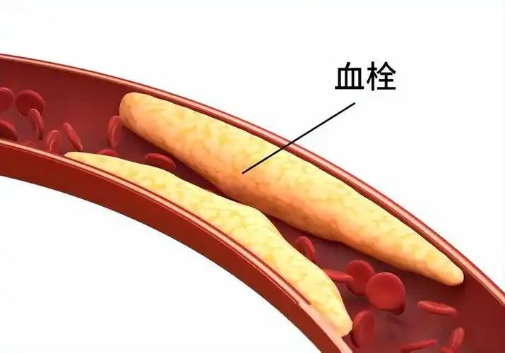 血栓的背后,真正的“黑手”被揪出来了!不是肥肉,也不是油炸,而是你天天都在吃的它