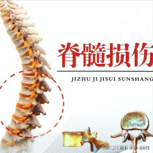 脊髓损伤警惕病情恶化！3大前兆要知道 1.肢体无力或麻木范围变大脊髓损伤
