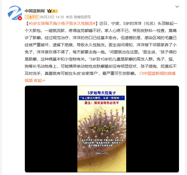 5岁女孩每天抱小兔子致永久性脱发宁波5岁男孩因每天抱邻居家的兔子，感染脓癣，头