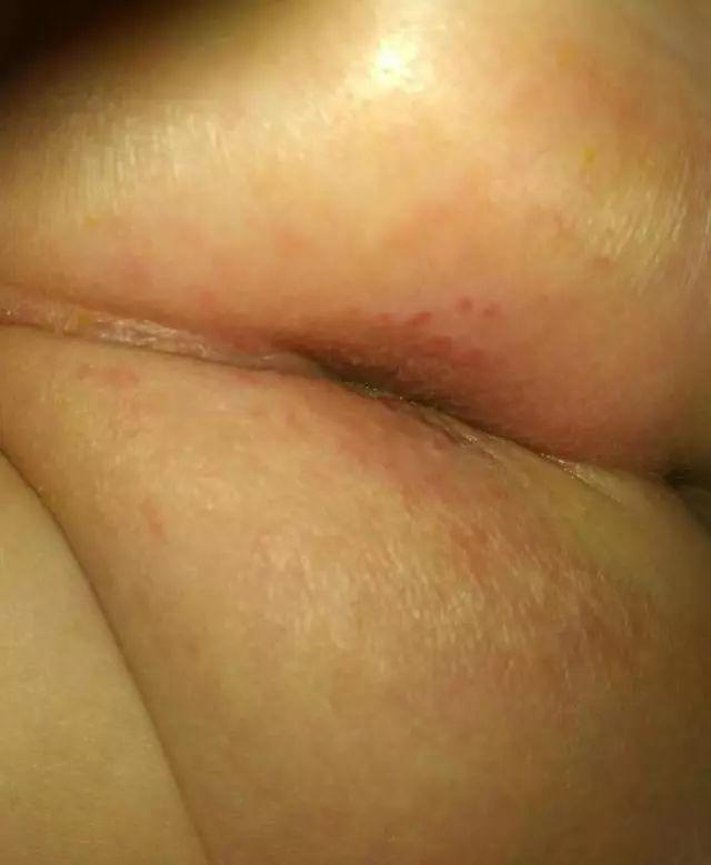 宝宝屁股红, 而且破皮了怎么办?