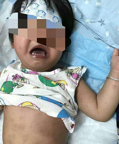 浙江2岁女宝宝40℃高热反复不退, 眼睛红得像兔子, 因这种病