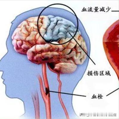 “头晕头痛找不到原因，小心是脑梗 生活中，很多人经常出现不明原因的头晕、头痛