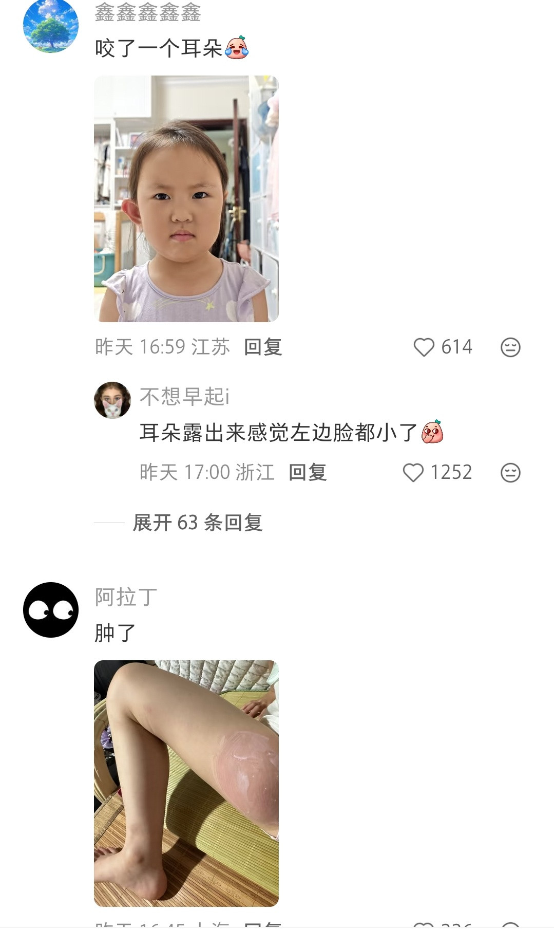 现在的蚊子🦟真是好毒[笑着哭]​​​