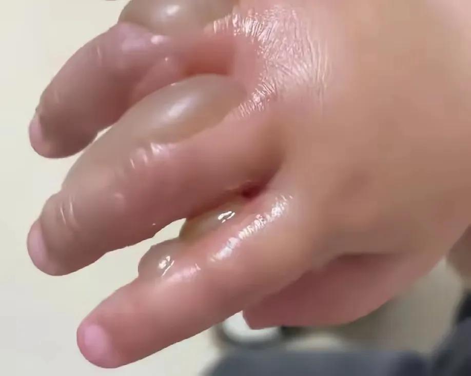 出大事了！孩子哭得撕心裂肺，张纪中心疼不已！这双稚嫩的小手被烫了，而罪魁祸首就是