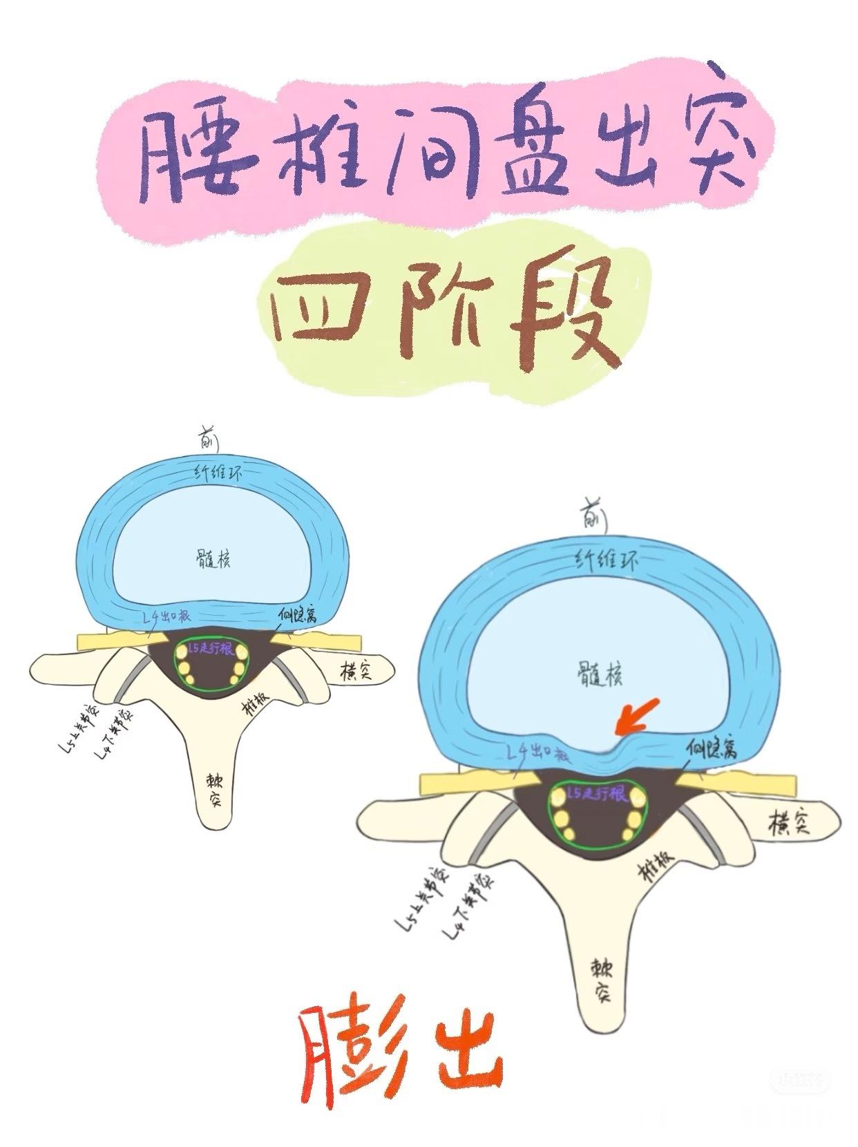 每日康复科普【腰突康复】今天接着科普——腰椎间盘突出由轻到重的四个阶段：【膨出