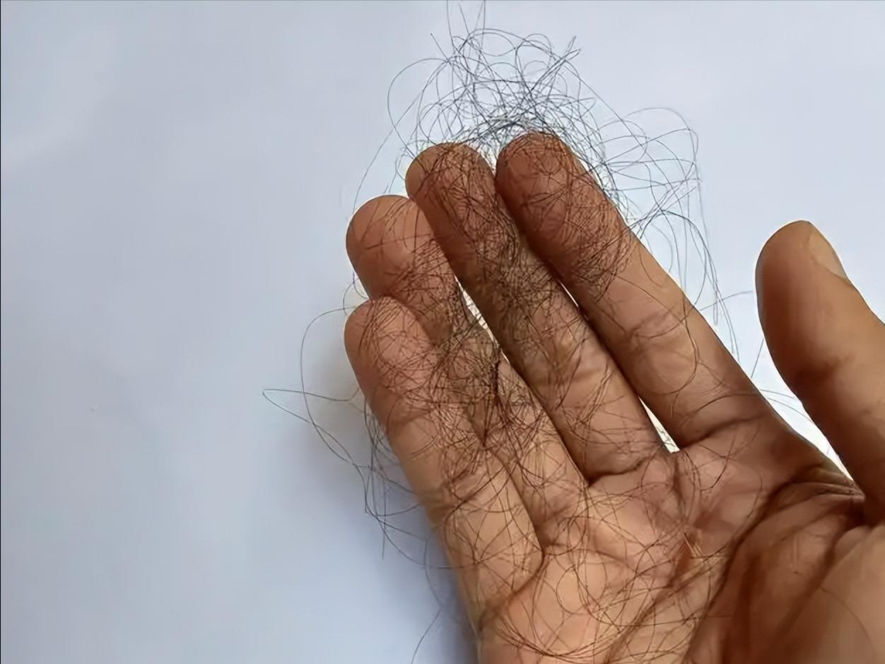 男性能活多久，看头发就知？提醒：若有这3症状，尽早引起重视头发这件事，男性普