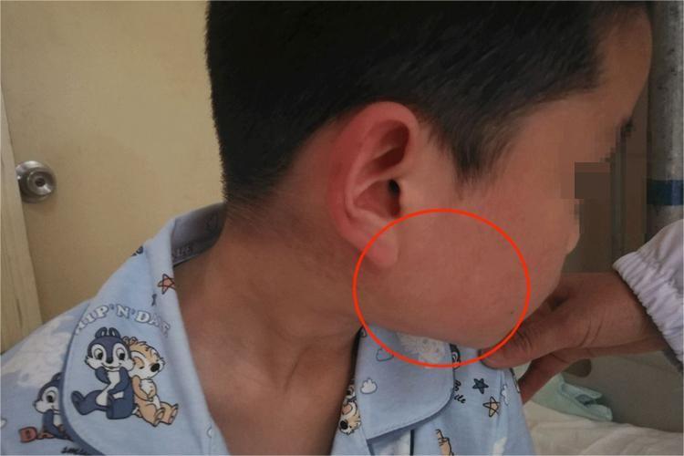 开学季腮腺炎高发！家长注意不要自行给孩子吃抗生素近期有儿童感染流行性腮腺炎的病