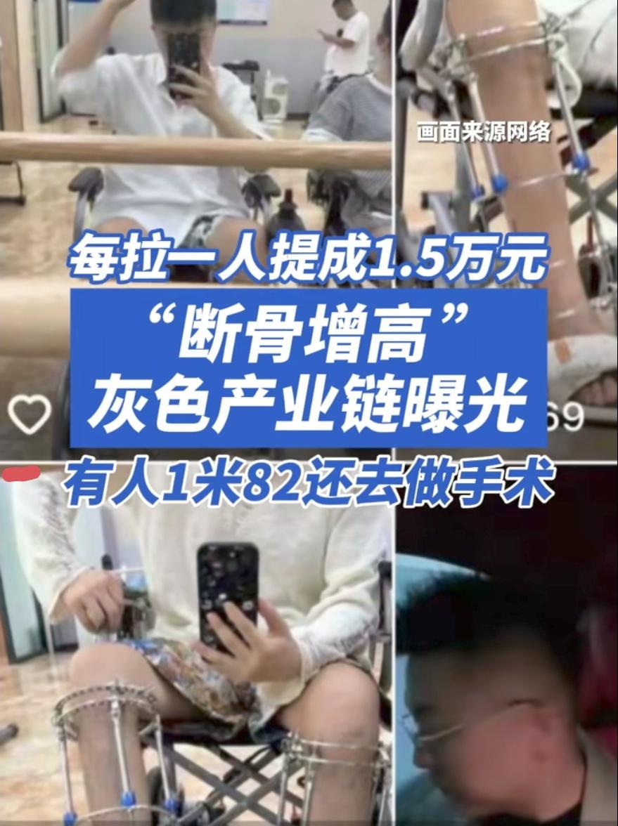 断骨增高被曝光，挖出的细节：1、断骨增高手术是明令禁做的医美黑手术，只允许