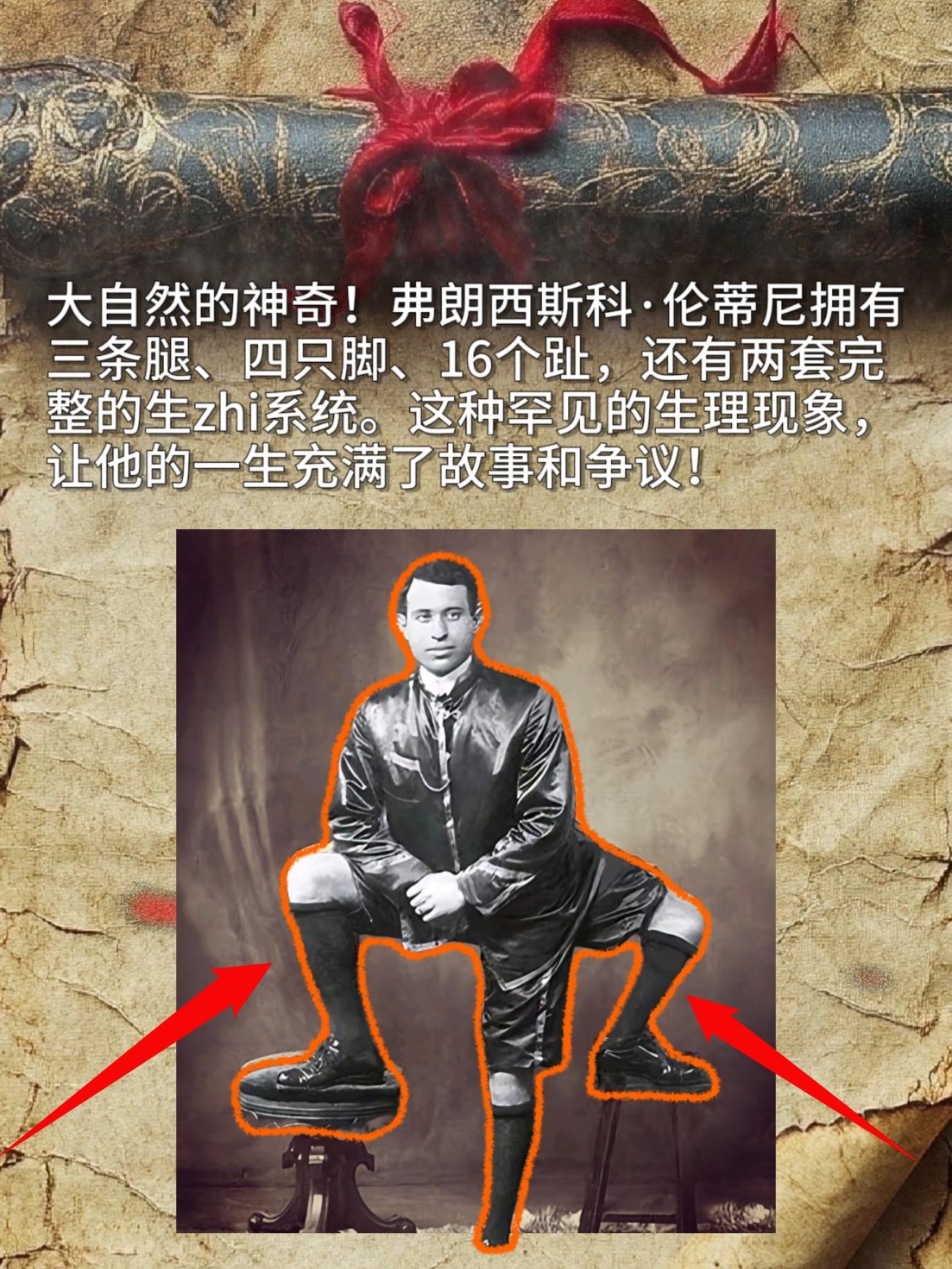 大自然的神奇！弗朗西斯科·伦蒂尼拥有三条腿、四只脚、16个趾，还有两套...