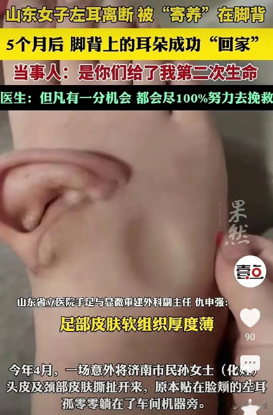脚背上长了一只耳朵👂，你没有看错，这是真实发生的一件事。山东一位女子因发生意外