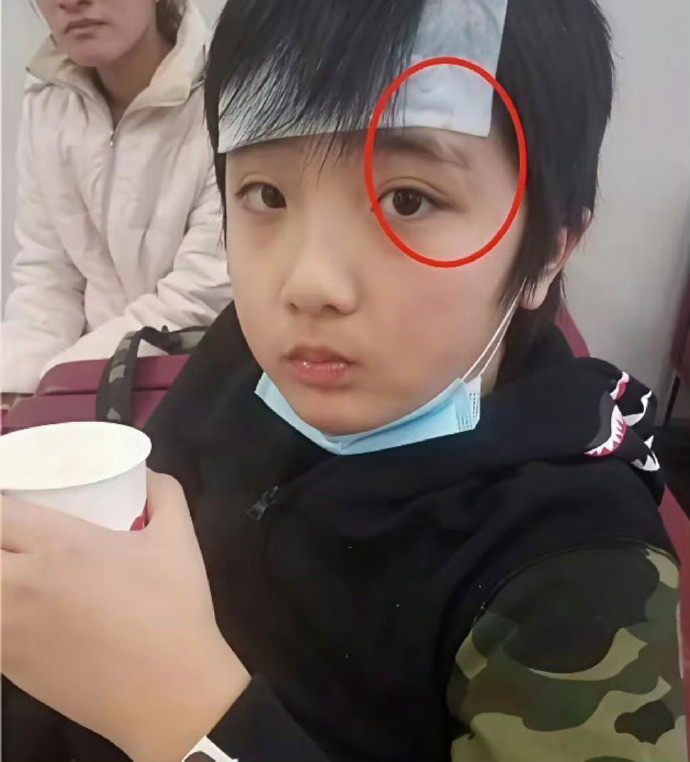 看到费曼脸上巨大的伤疤，感觉当年吴镇宇怒摔话筒算轻的了